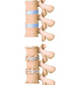 columna vertebral sana y afectada por osteocondrosis