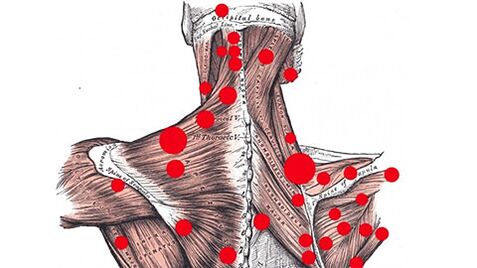 Puntos gatillo en los músculos que provocan dolor de espalda miofascial