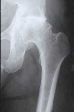 Imagen de resonancia magnética de la articulación de la cadera afectada