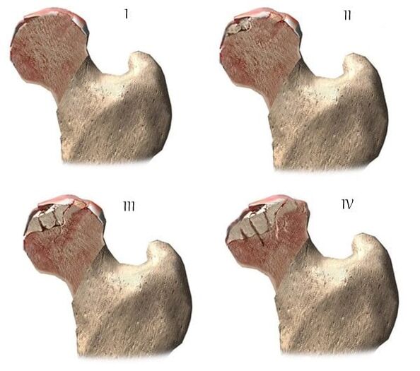 etapas de la artrosis de la articulación de la cadera