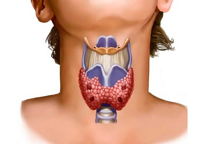 problemas de tiroides como causa de dolor de cuello