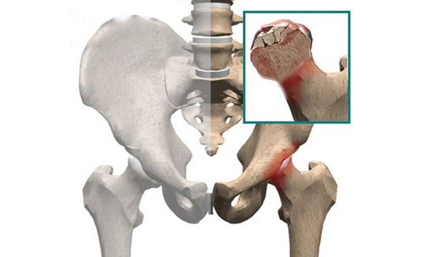 La necrosis de la cabeza femoral es una de las causas del dolor en la articulación de la cadera. 