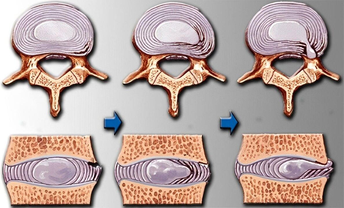 etapas de la osteocondrosis