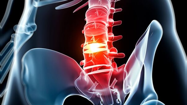 osteocondrosis de la columna lumbar