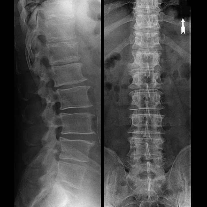 osteocondrosis de la región vertebral en rayos X