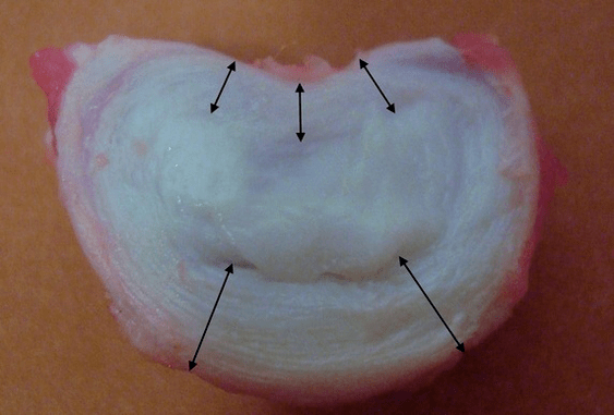 ¿Cómo se ve un disco intervertebral