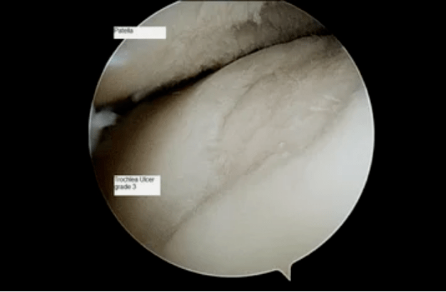 Vista astroscópica de una articulación de rodilla con artrosis de tercer grado.