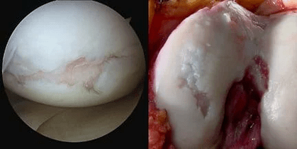 imagen de la superficie de la articulación de la rodilla