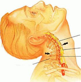Osteocondrosis de la columna cervical.